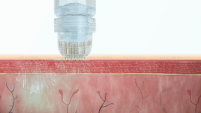 Advanced Micro - Infusion Hair Regrowth Kit